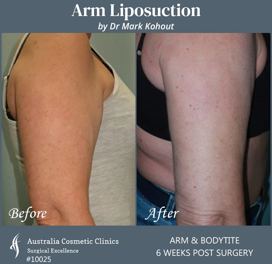 Arm Liposuction Patient 10025 SIDE