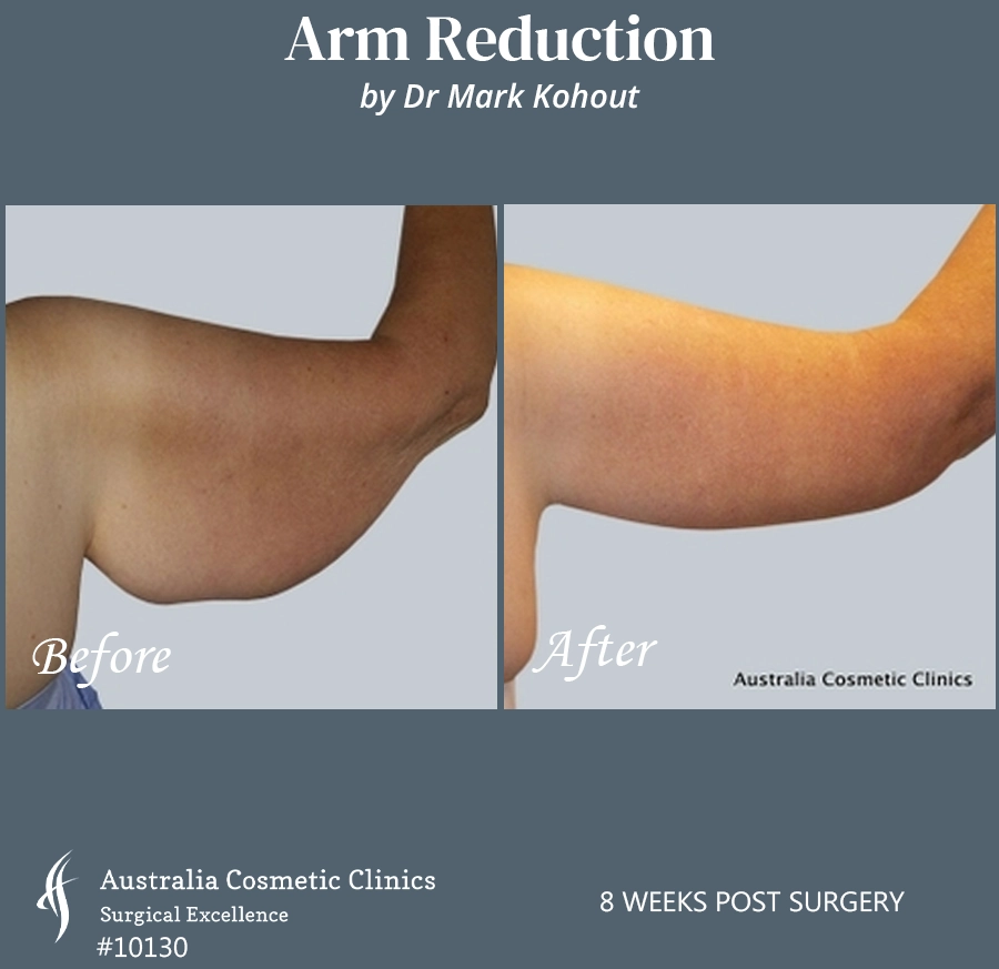 Arm Reduction Patient 10130 Back