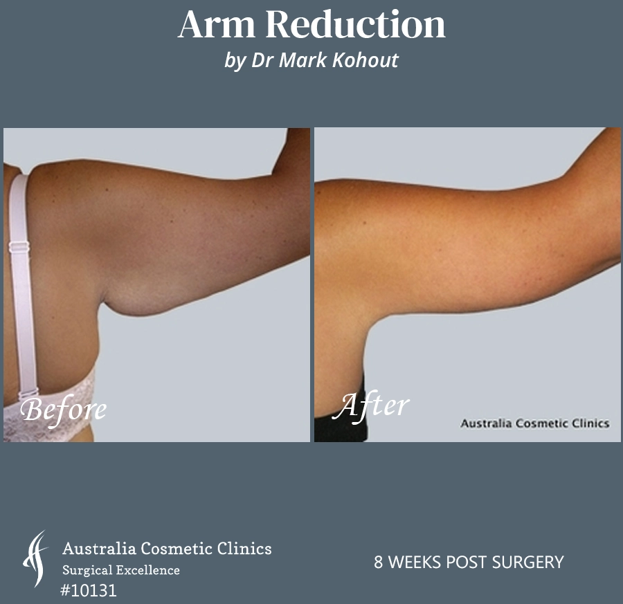 Arm Reduction Patient 10131 Back