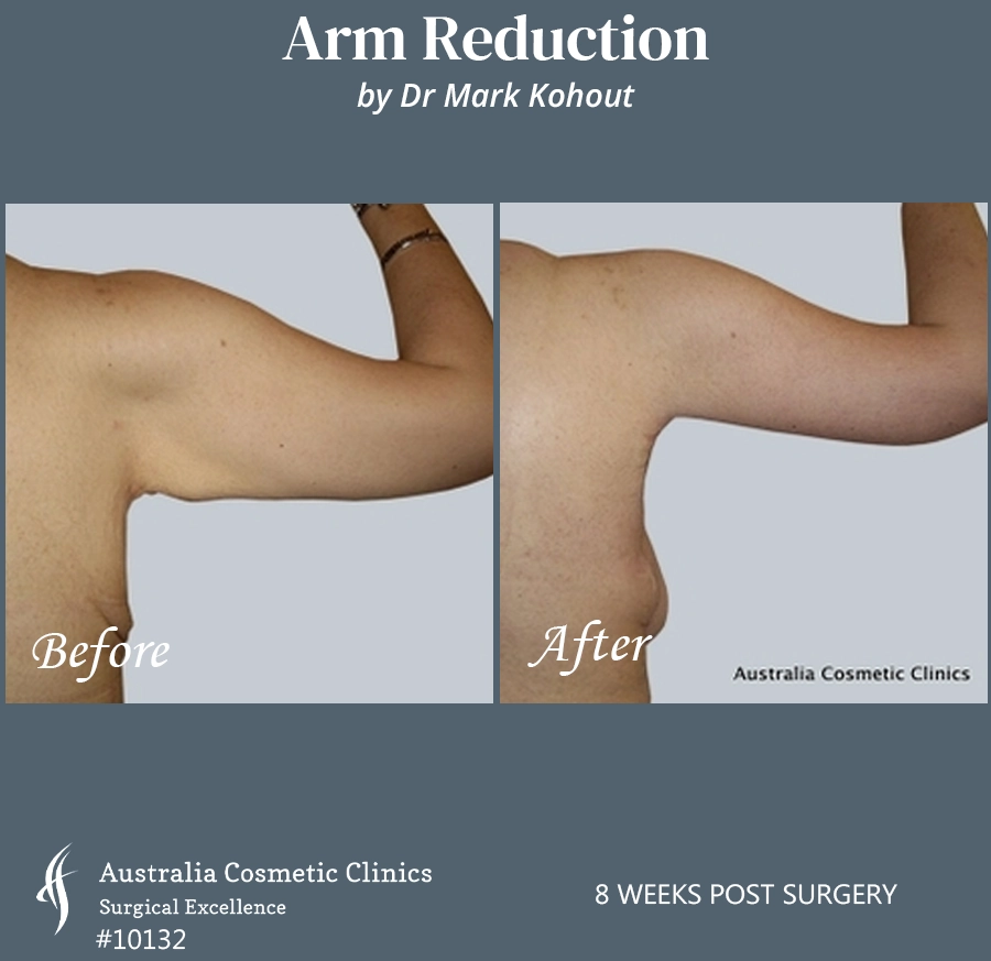 Arm Reduction Patient 10132 Back