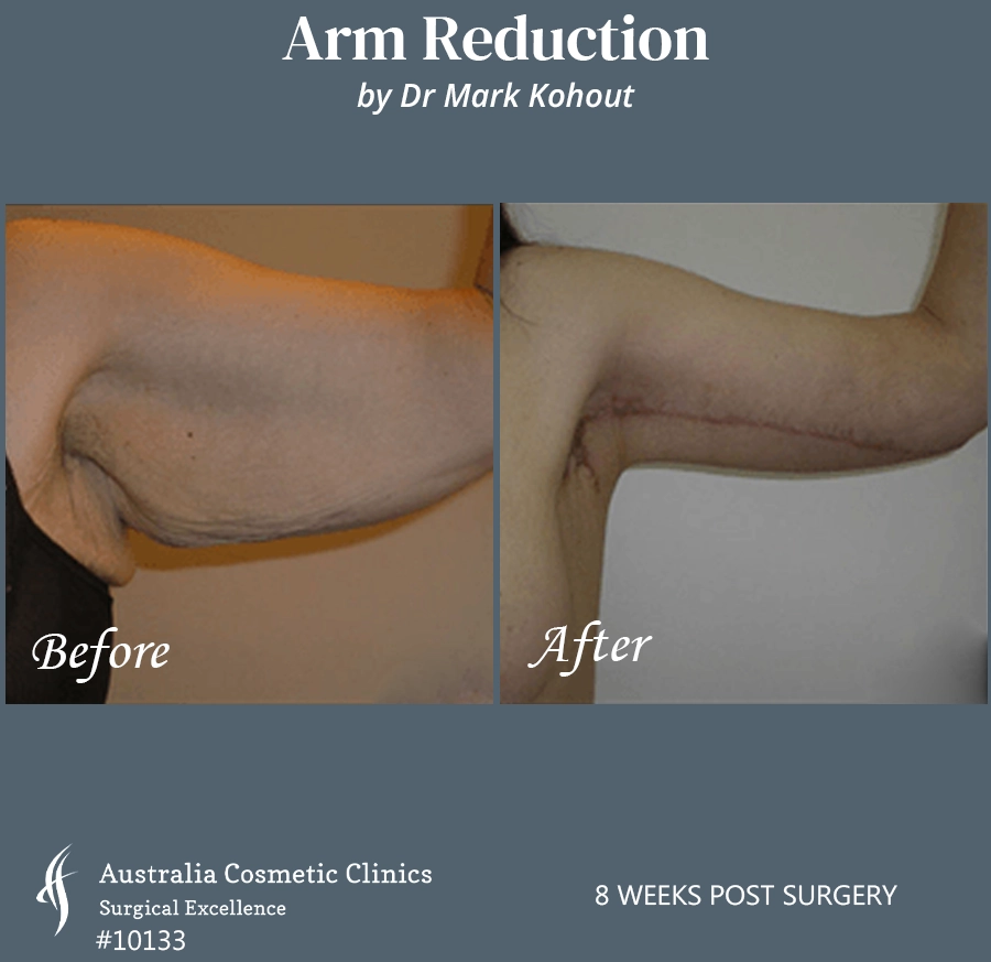 Arm Reduction Patient 10133 Front