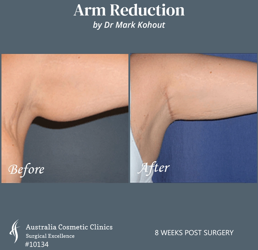 Arm Reduction Patient 10134 Front