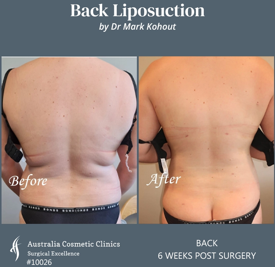 Back Liposuction Patient 10026 BACK
