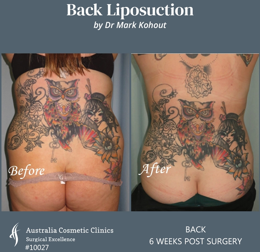Back Liposuction Patient 10027 BACK