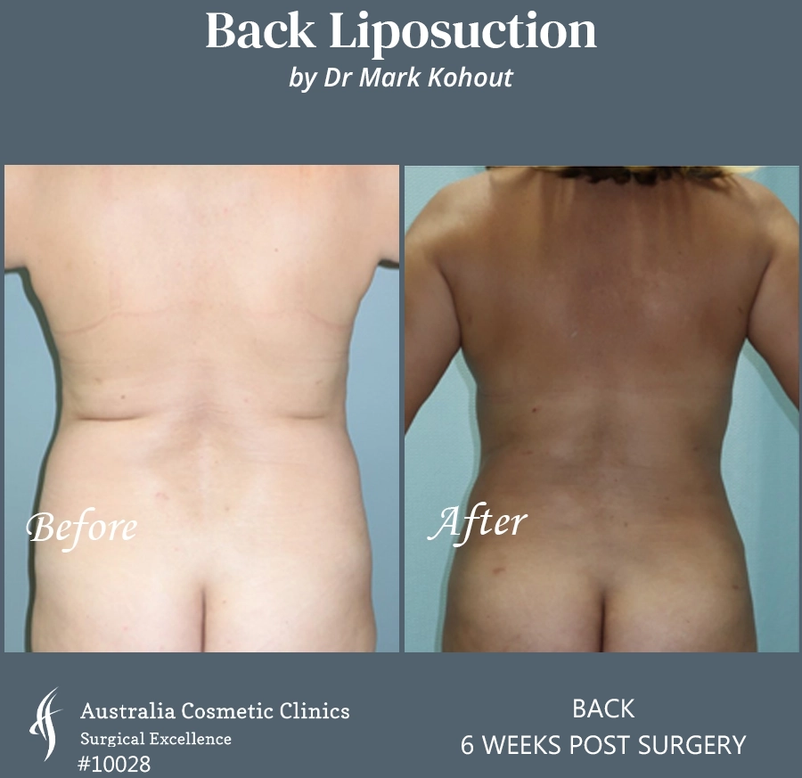 Back Liposuction Patient 10028 BACK