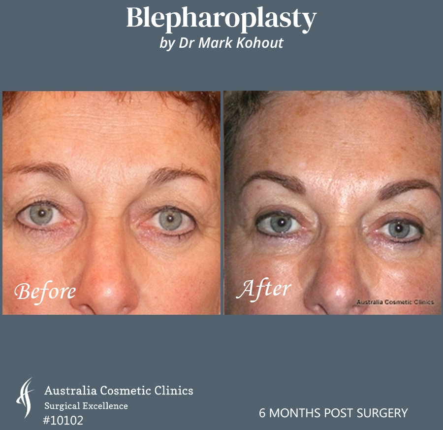 Blepharoplasty Patient 10102 Front