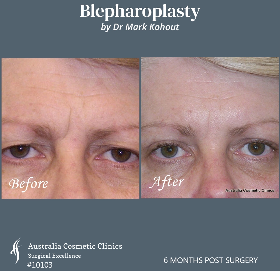 Blepharoplasty Patient 10103 Front