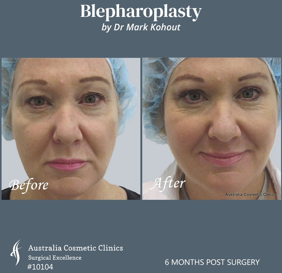 Blepharoplasty Patient 10104 Front