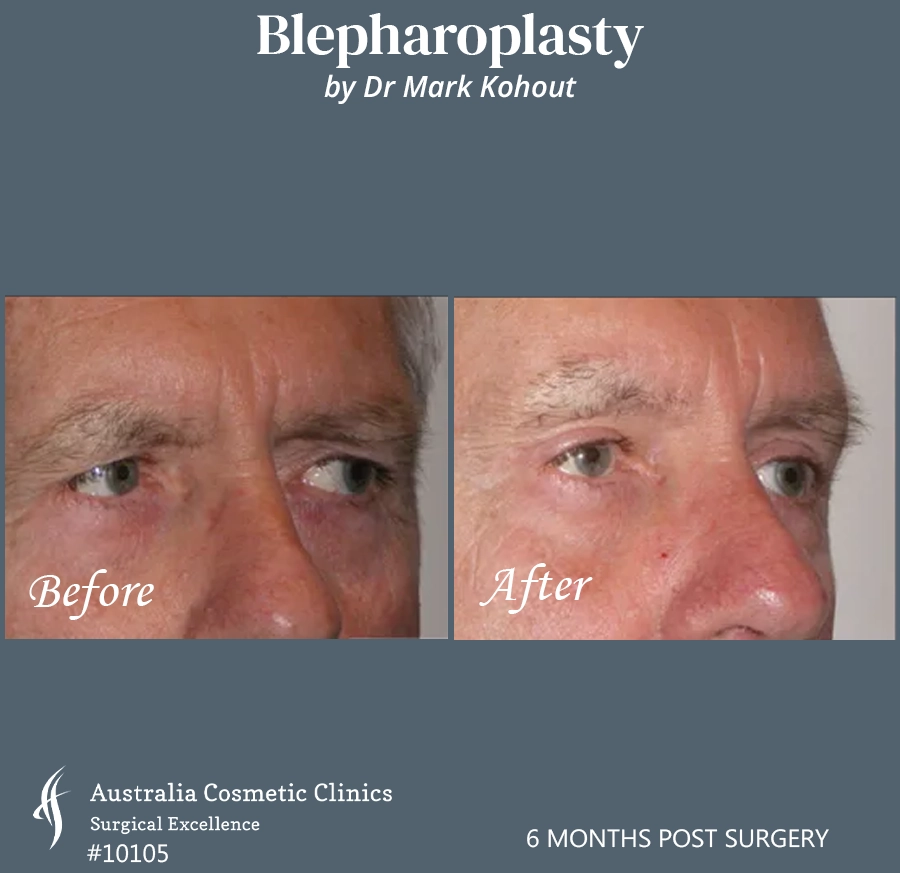 Blepharoplasty Patient 10105 45