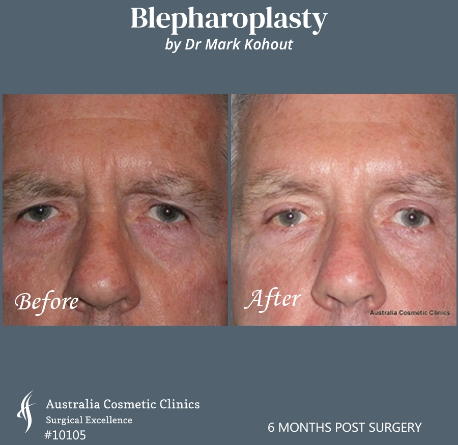 Blepharoplasty Patient 10105 Front