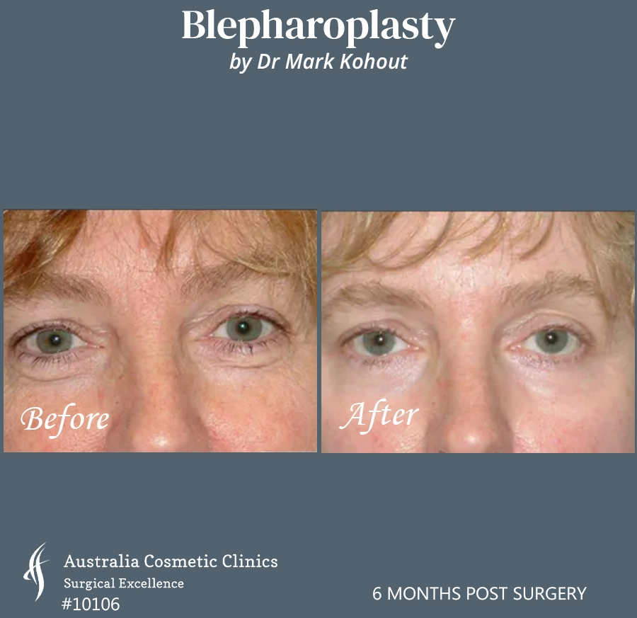 Blepharoplasty Patient 10106 Front
