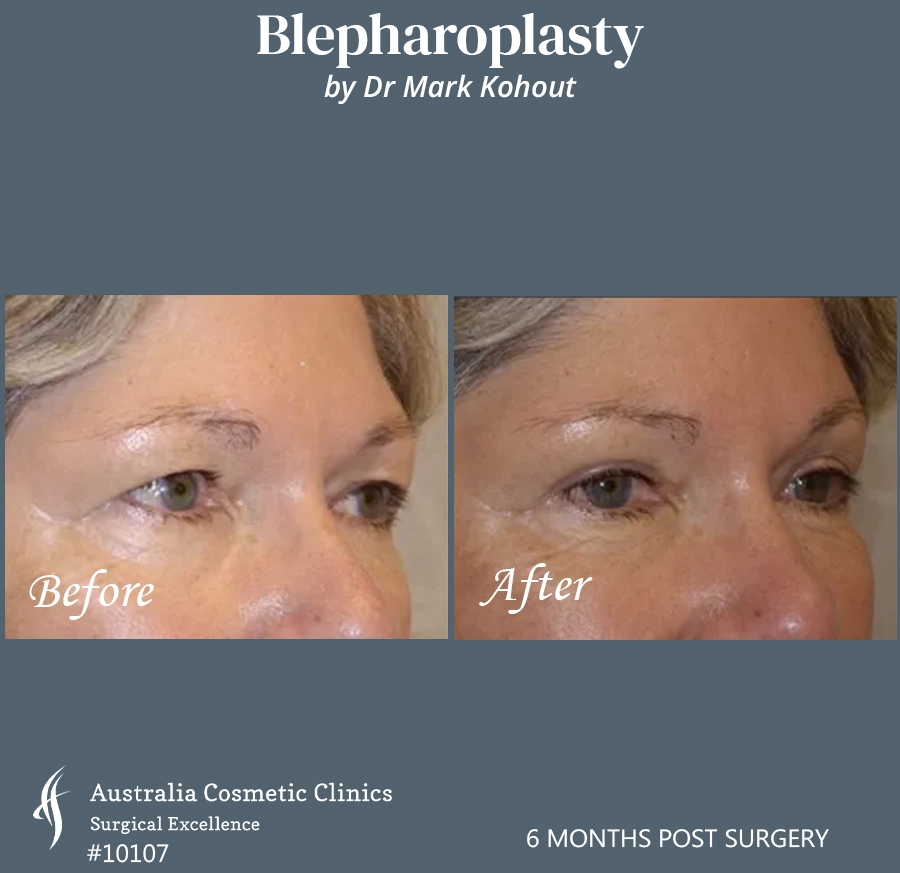 Blepharoplasty Patient 10107 45