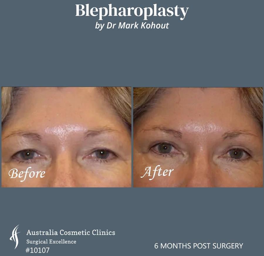 Blepharoplasty Patient 10107 Front