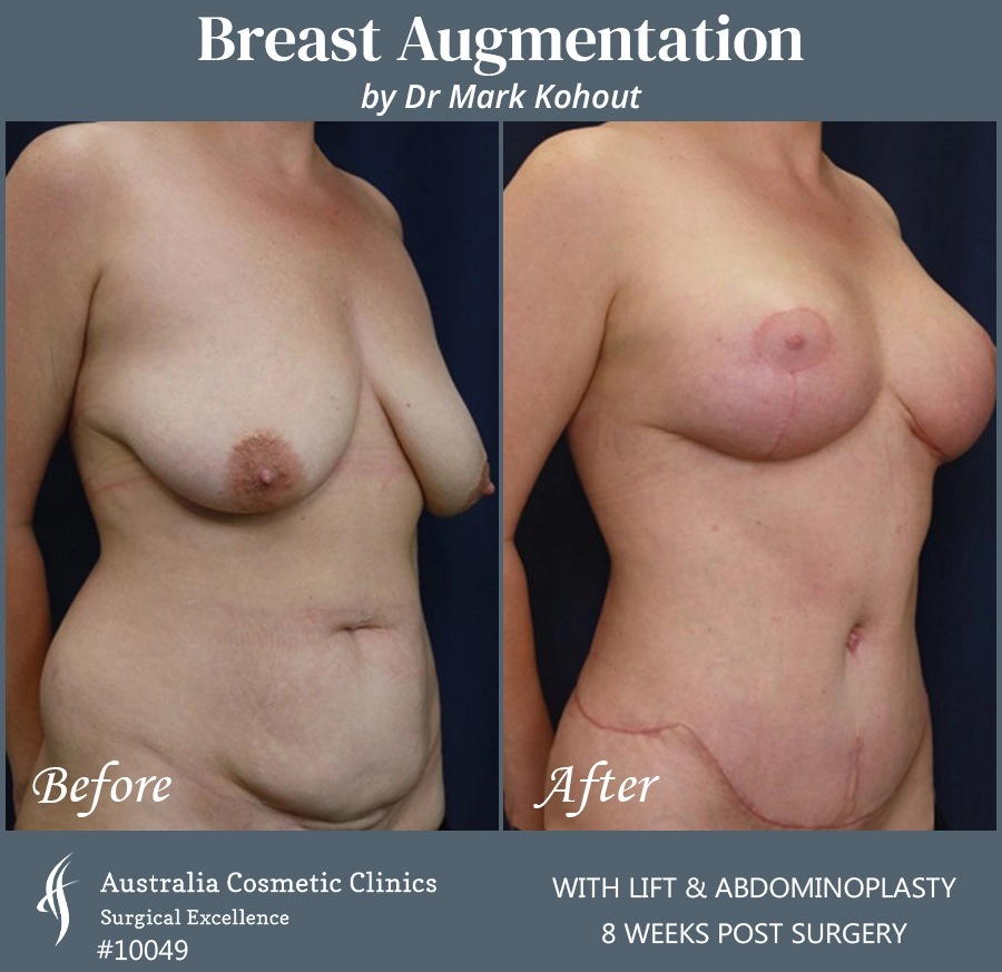 Breast Augmentation with Lift Patient 10049 45