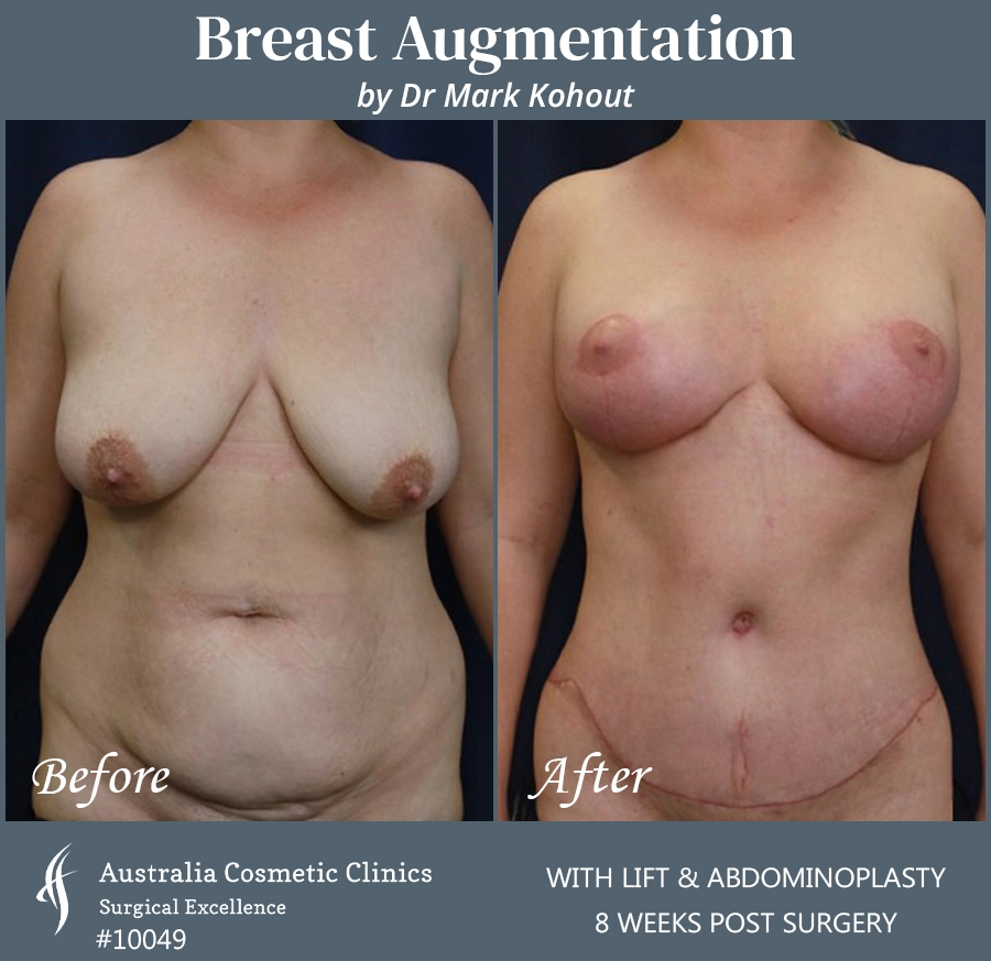Breast Augmentation with Lift Patient 10049 FRONT