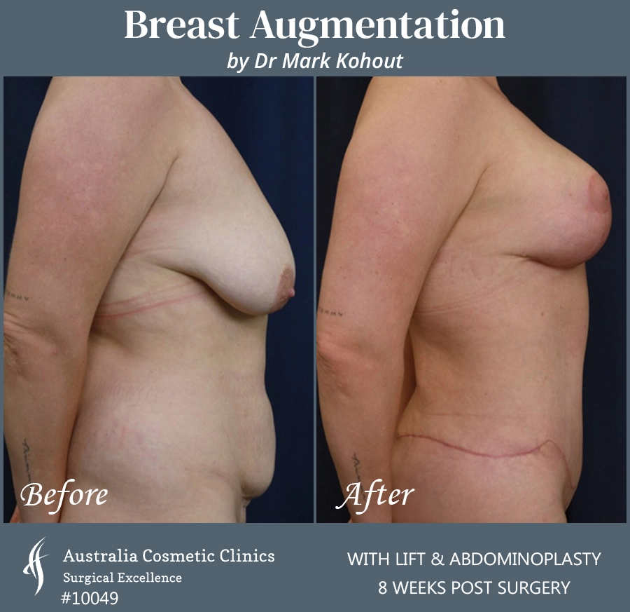 Breast Augmentation with Lift Patient 10049 SIDE