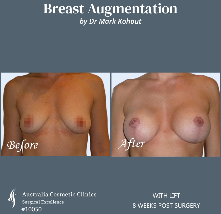 Breast Augmentation with Lift Patient 10050 FRONT
