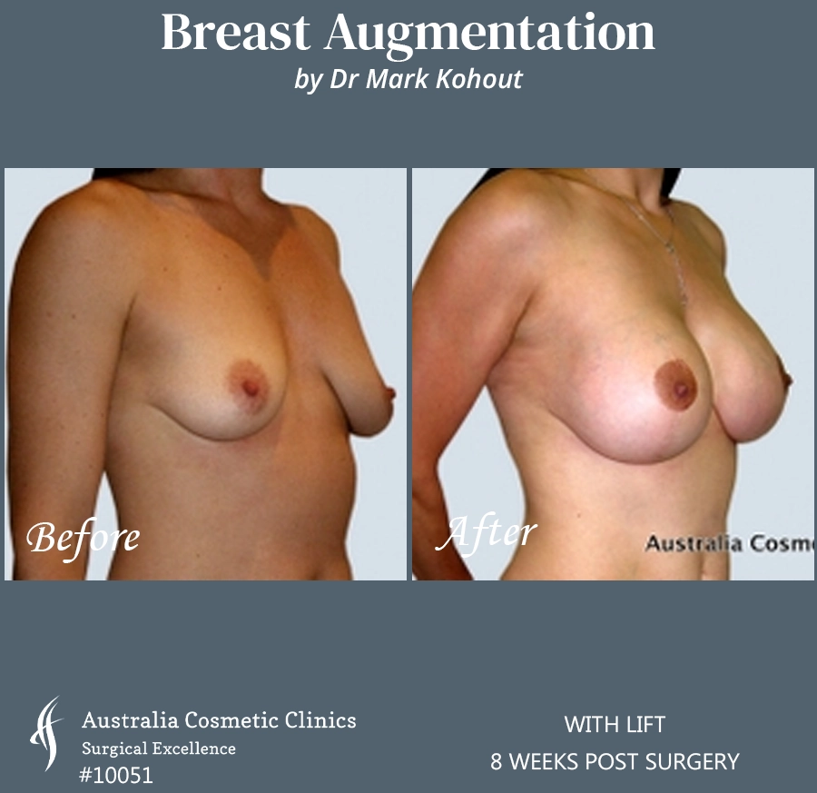 Breast Augmentation with Lift Patient 10051 45