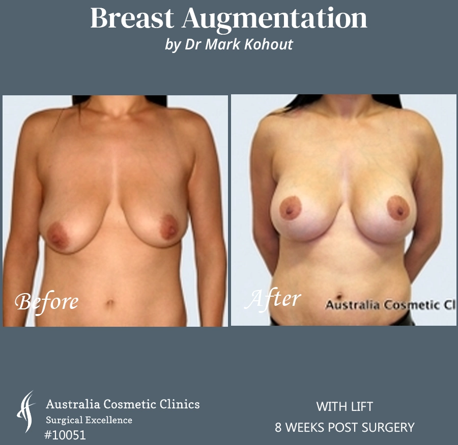 Breast Augmentation with Lift Patient 10051 FRONT