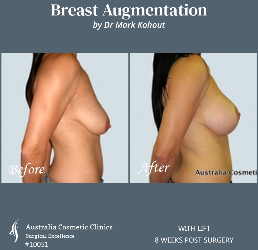 Breast Augmentation with Lift Patient 10051 SIDE