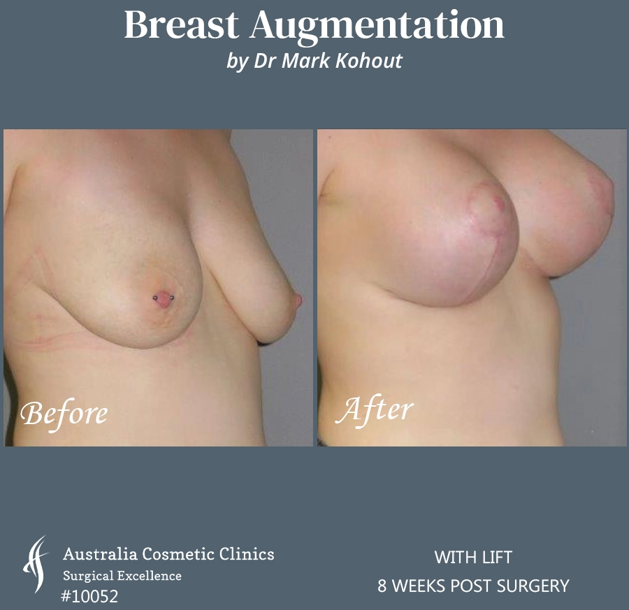 Breast Augmentation with Lift Patient 10052 45