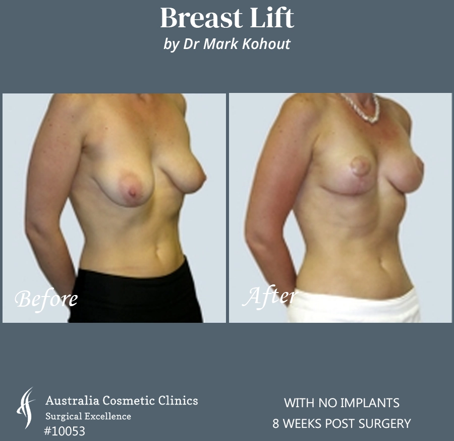 Breast Lift With No Implants Patient 10053 45