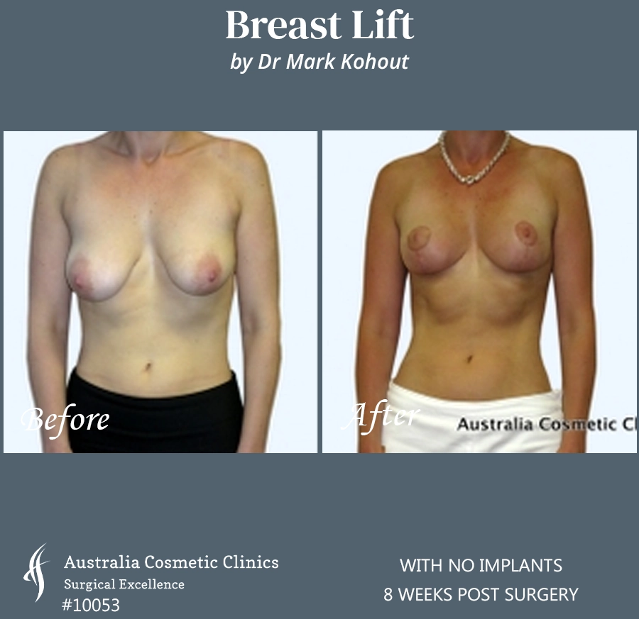 Breast Lift With No Implants Patient 10053 FRONT