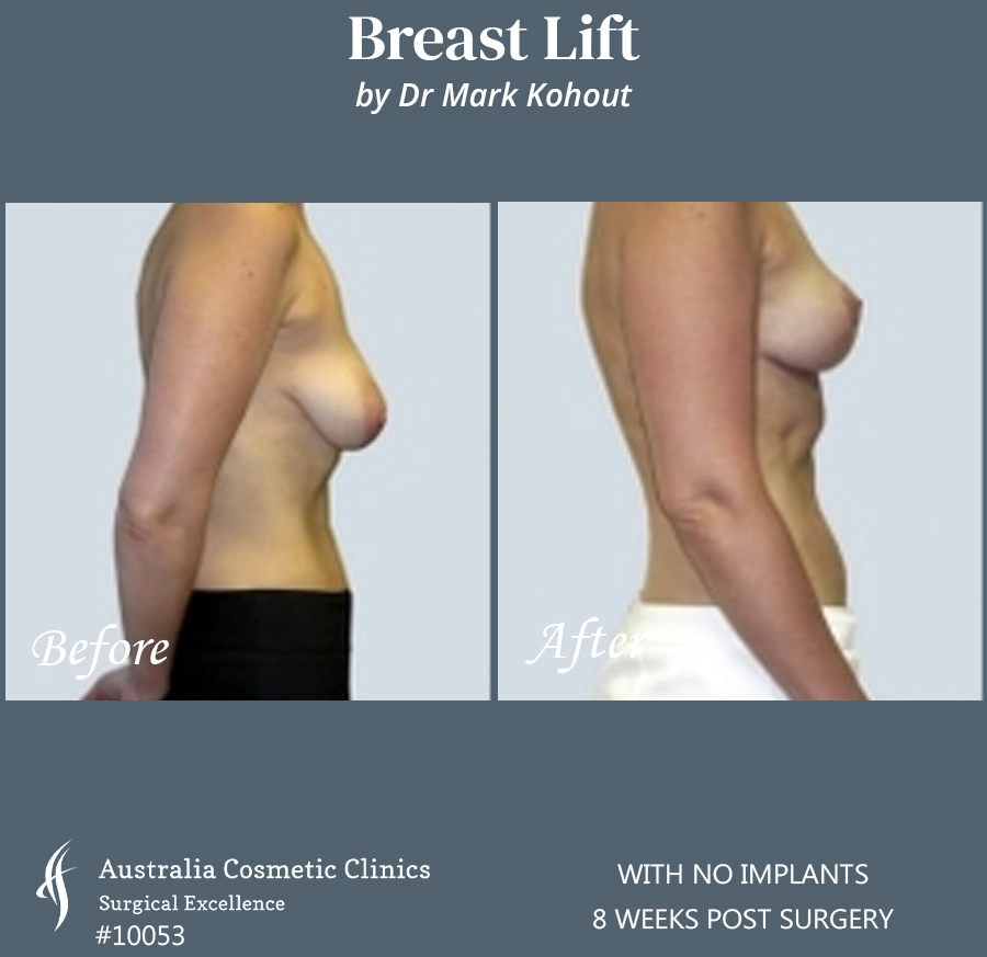 Breast Lift With No Implants Patient 10053 SIDE
