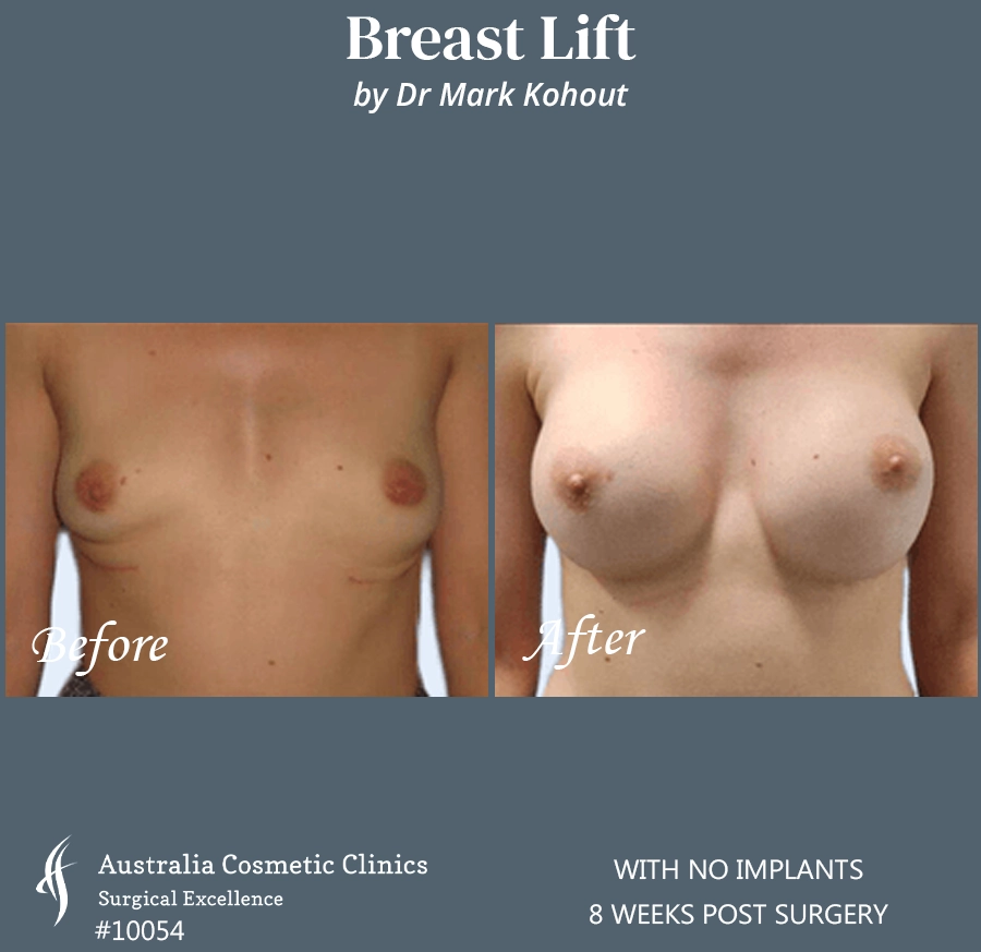 Breast Lift With No Implants Patient 10054 FRONT