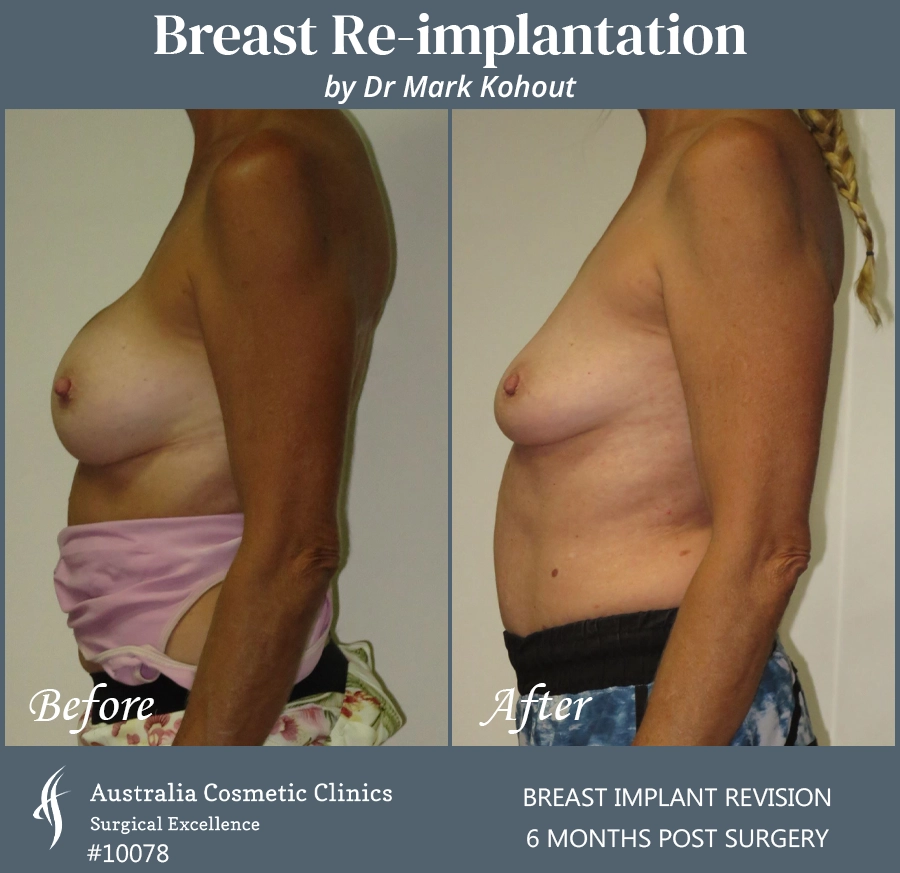 Breast Reimplantation Patient 10078 Side