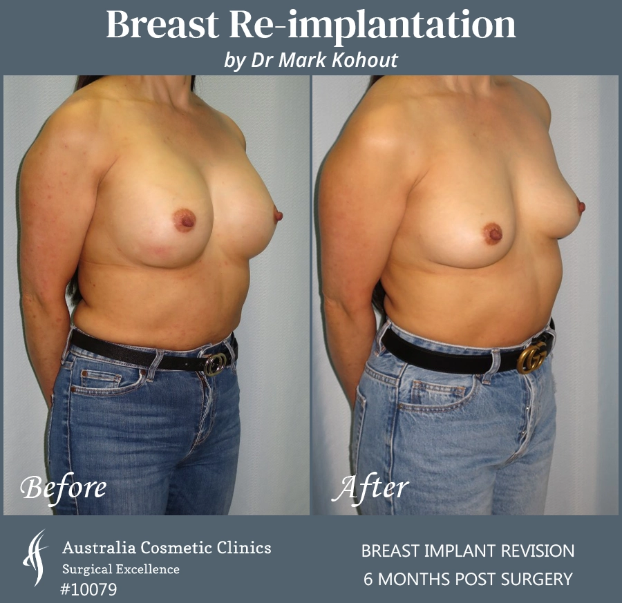 Breast Reimplantation Patient 10079 45