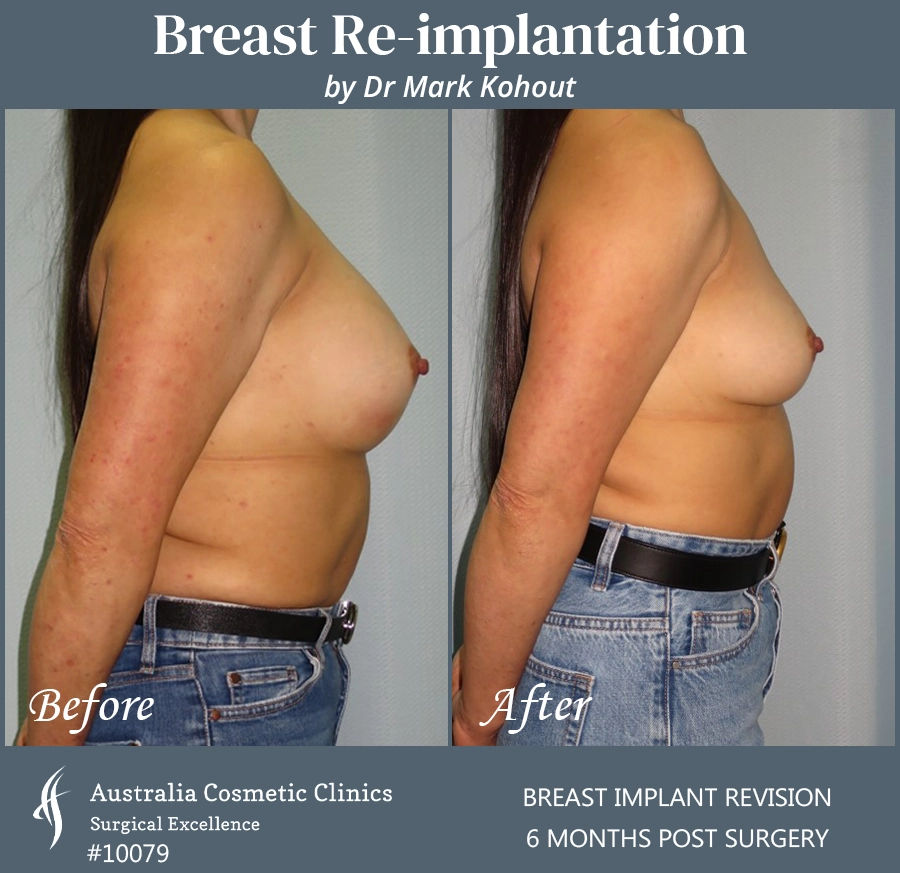 Breast Reimplantation Patient 10079 Side