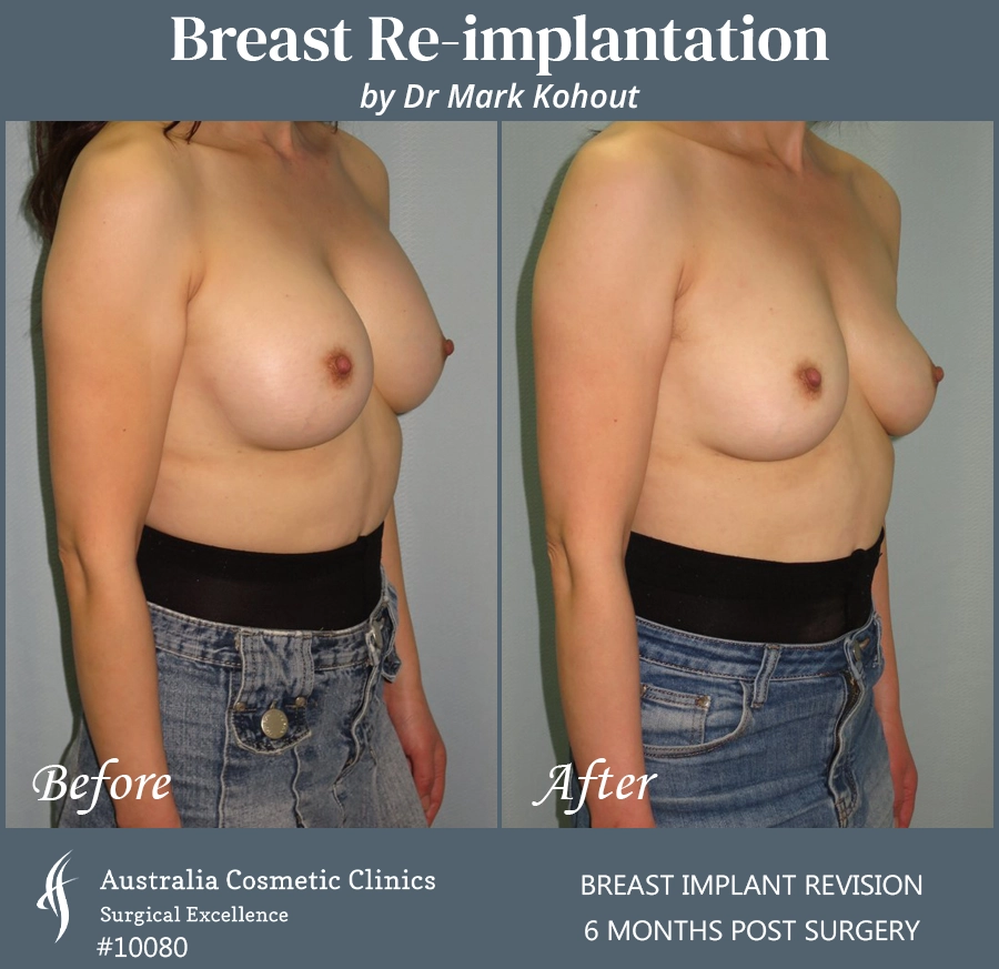 Breast Reimplantation Patient 10080 45