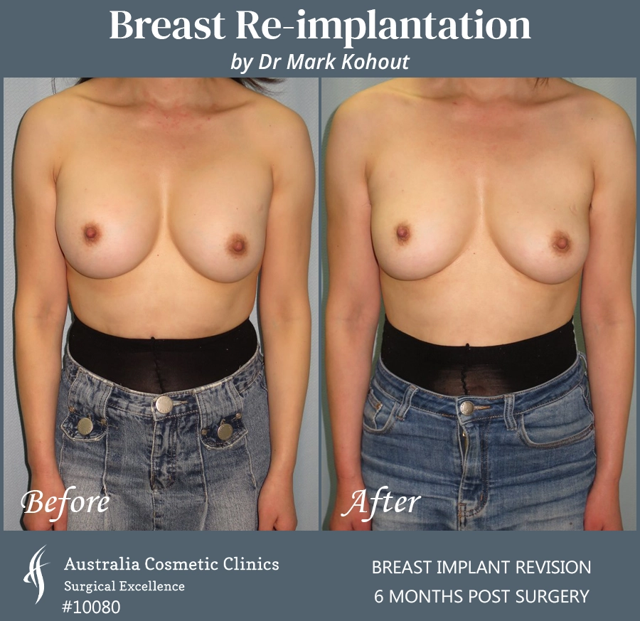 Breast Reimplantation Patient 10080 Front
