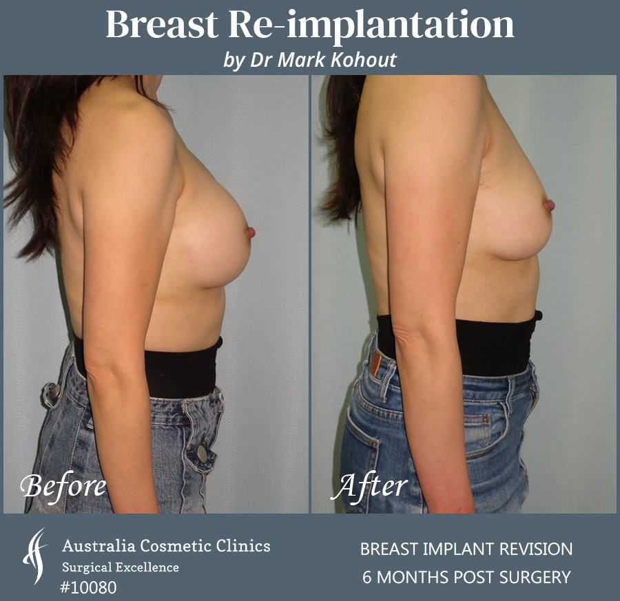 Breast Reimplantation Patient 10080 Side