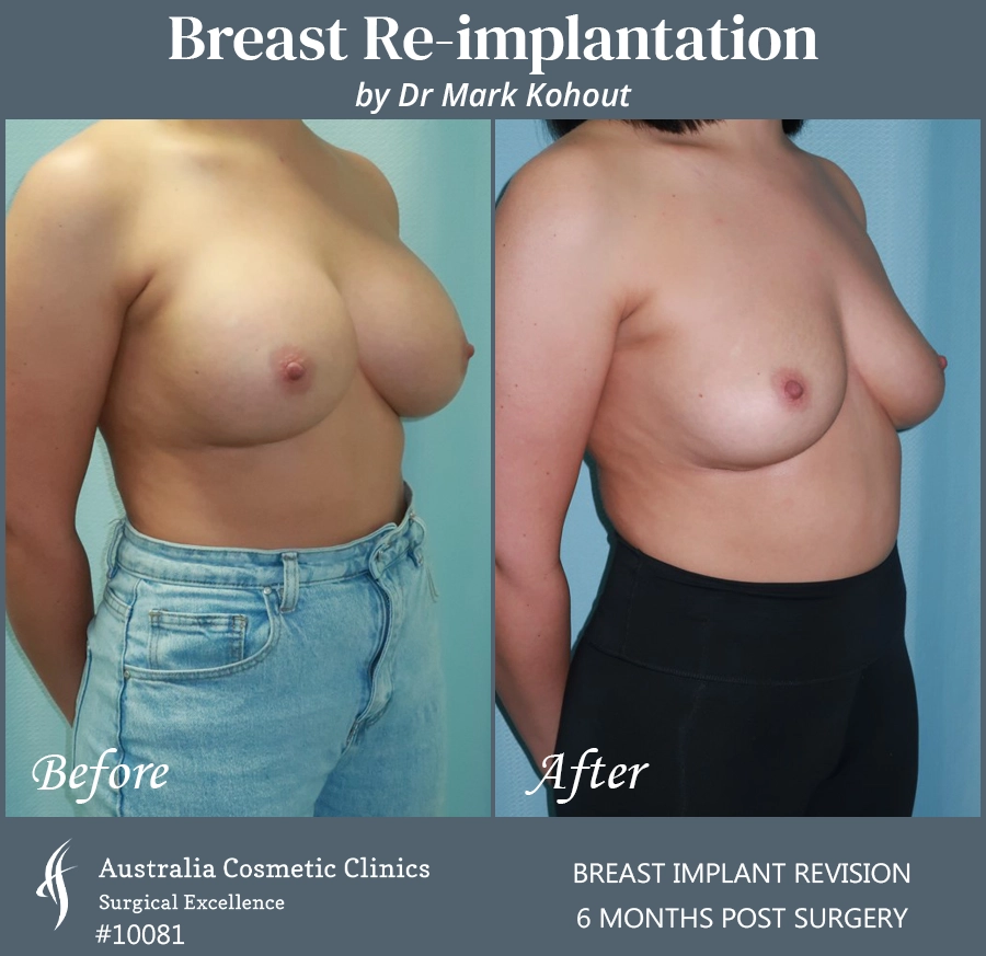 Breast Reimplantation Patient 10081 45