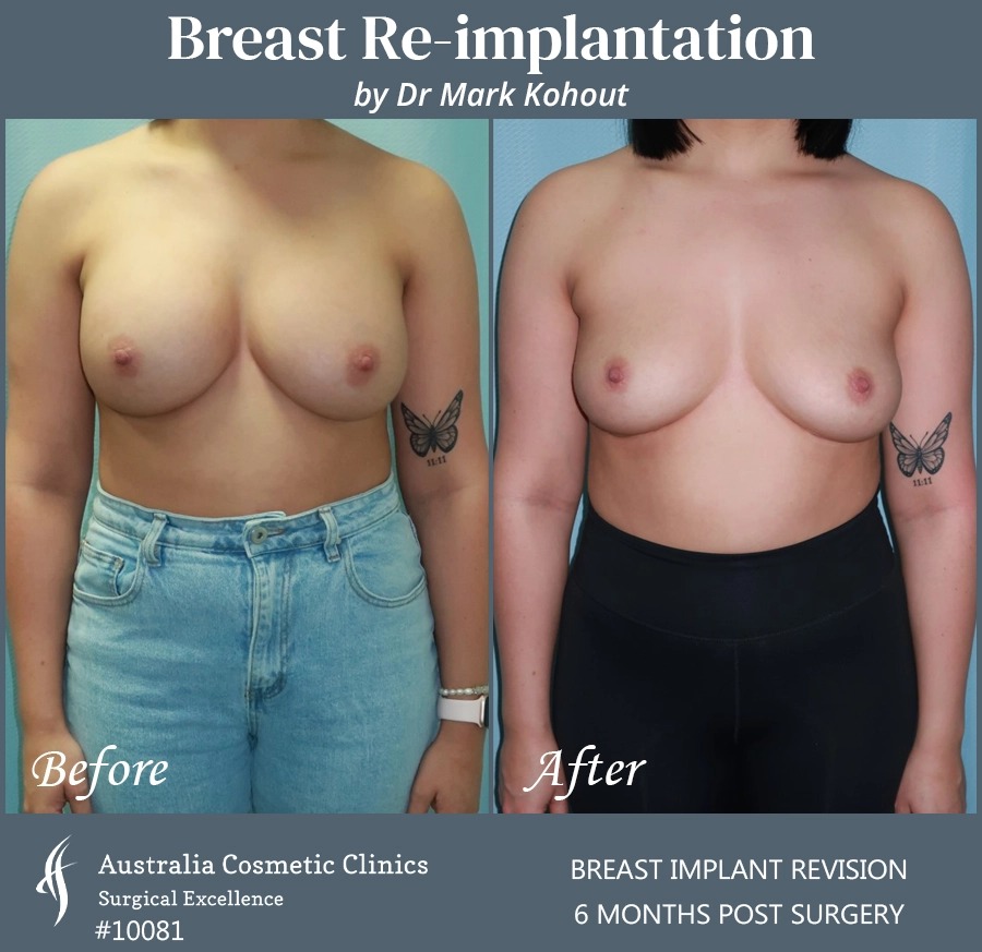 Breast Reimplantation Patient 10081 Front