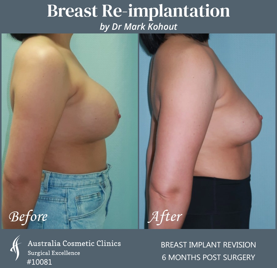 Breast Reimplantation Patient 10081 Side