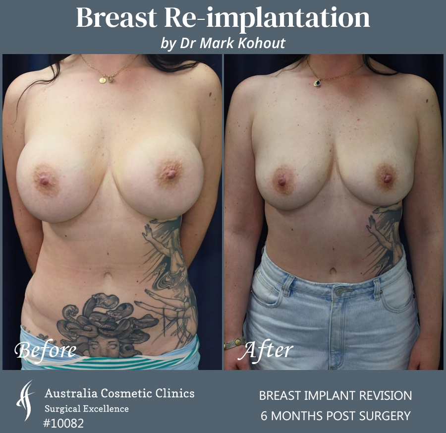 Breast Reimplantation Patient 10082 Front