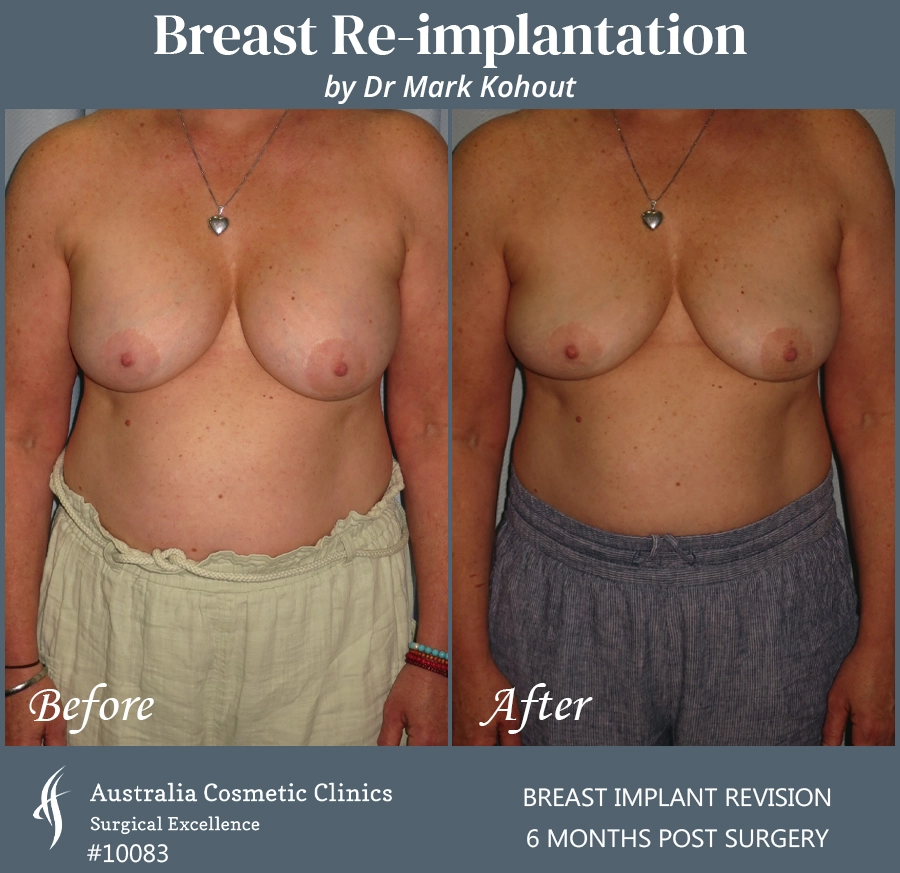 Breast Reimplantation Patient 10083 Front