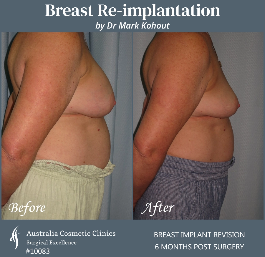 Breast Reimplantation Patient 10083 Side