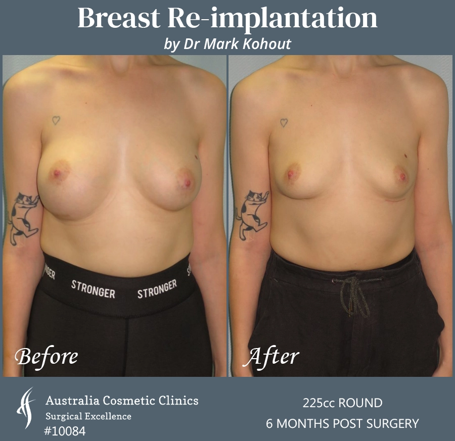 Breast Reimplantation Patient 10084 Front