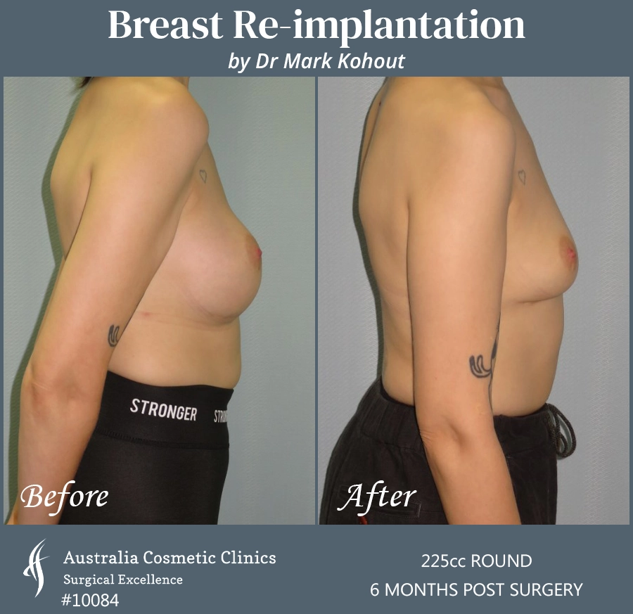 Breast Reimplantation Patient 10084 Side