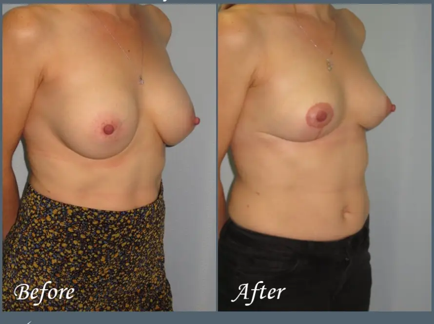 Breast Reimplantation Patient 10085 45