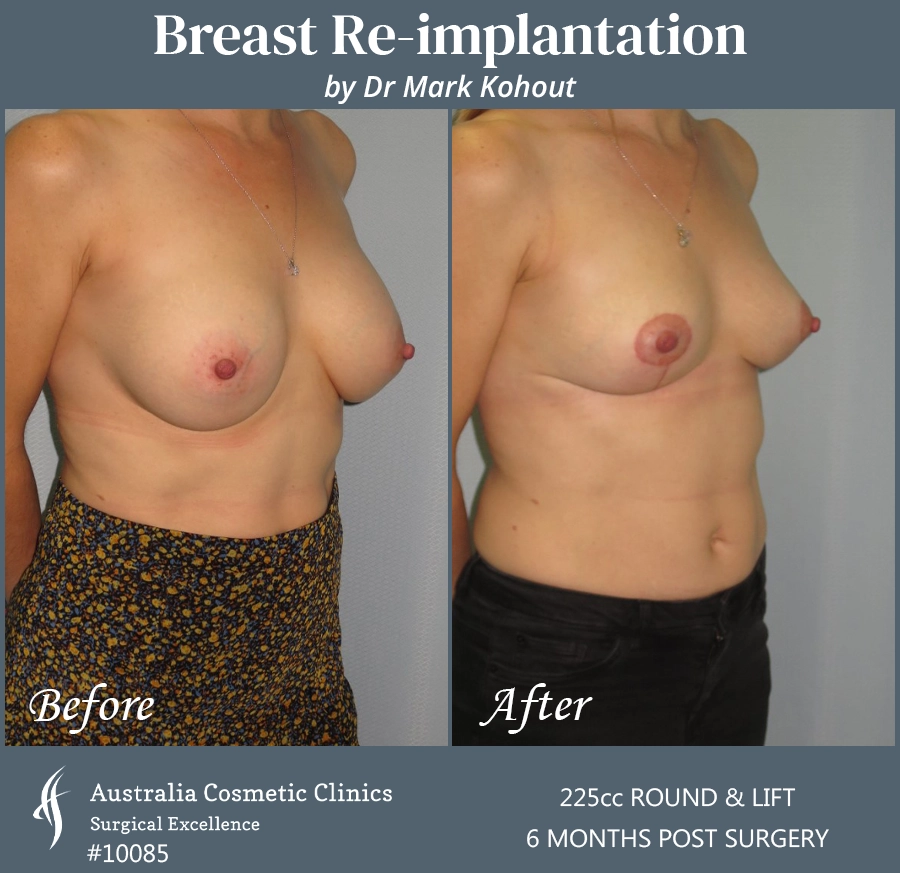 Breast Reimplantation Patient 10085 45