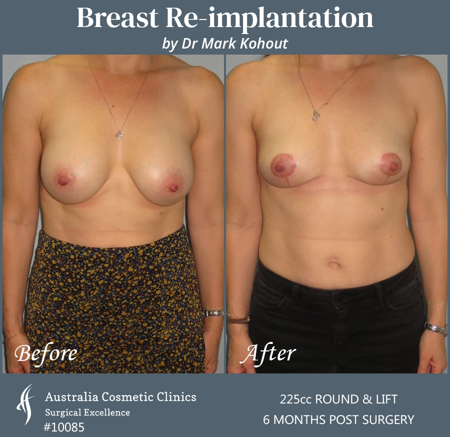 Breast Reimplantation Patient 10085 Front