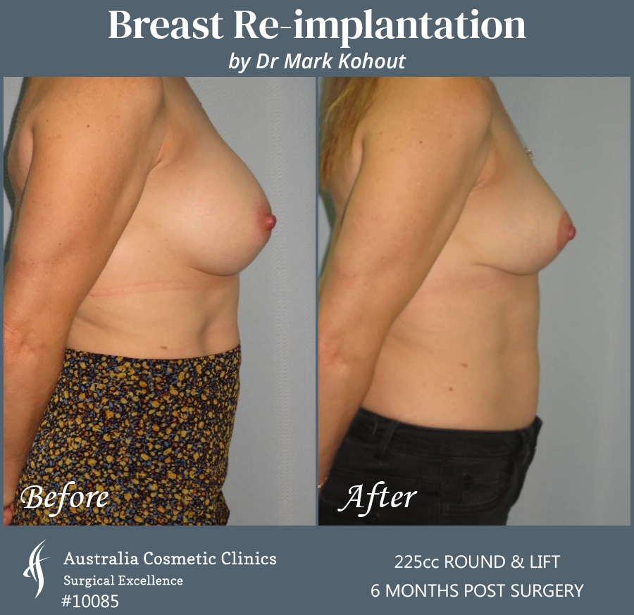 Breast Reimplantation Patient 10085 Side