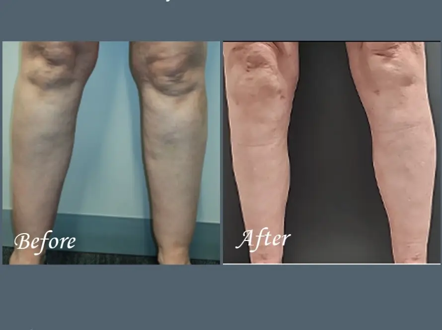 Calf Liposuction Patient 10029 FRONT
