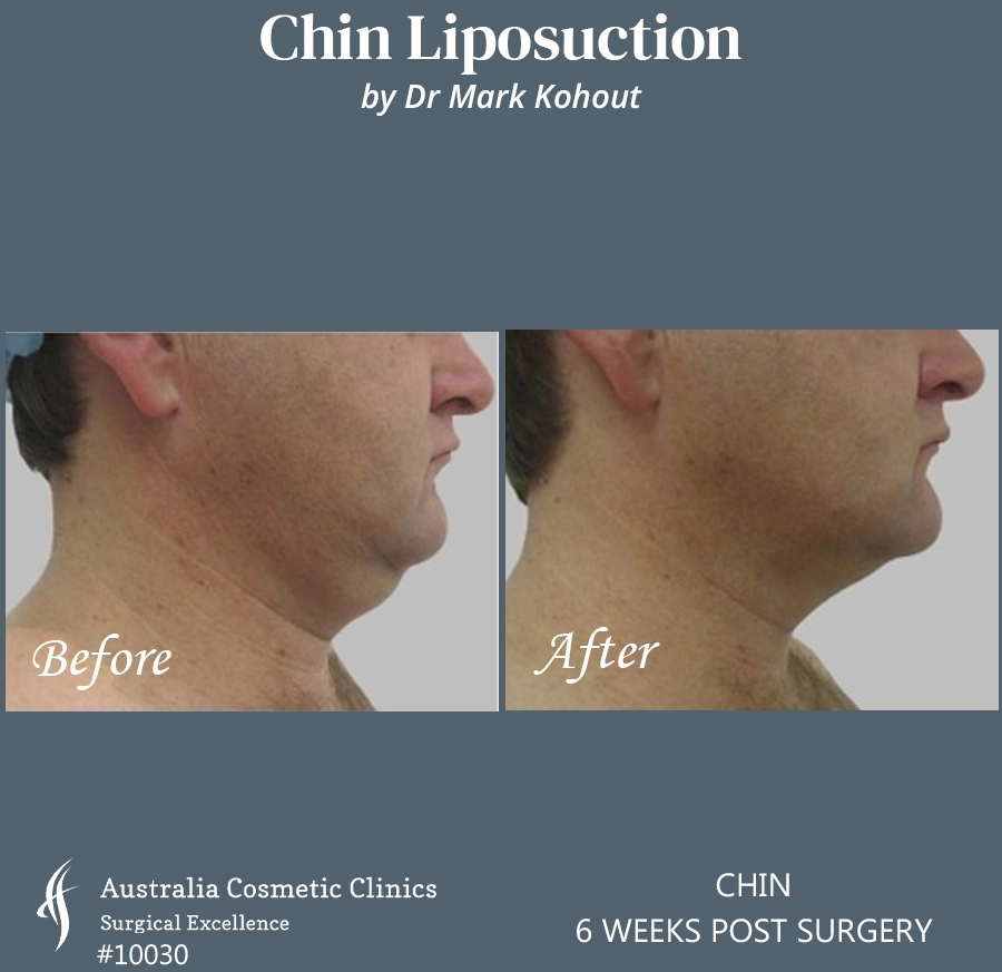 Chin Liposuction Patient 10030 LEFT SIDE