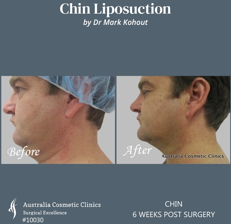 Chin Liposuction Patient 10030 RIGHT SIDE